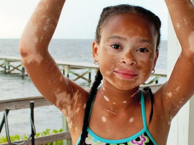 Médicos cubanos descobriram cura para vitiligo