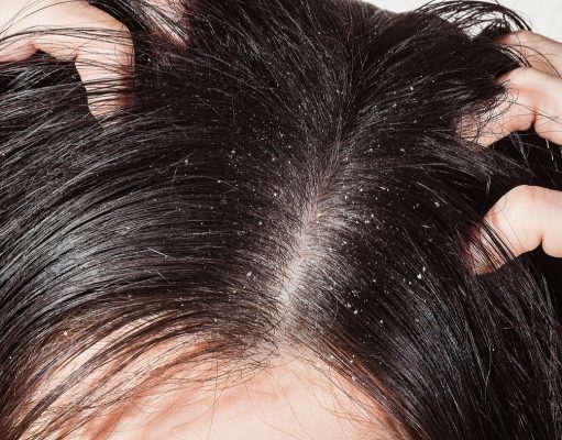 Confira 8 dicas para acabar com a caspa para sempre